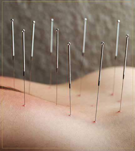 Acupuncture